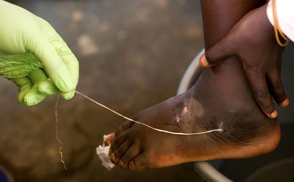 Afrique centrale : un chercheur explique la recrudescence du Ver de Guinée au Tchad